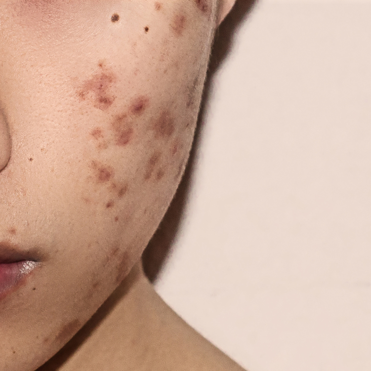 acne