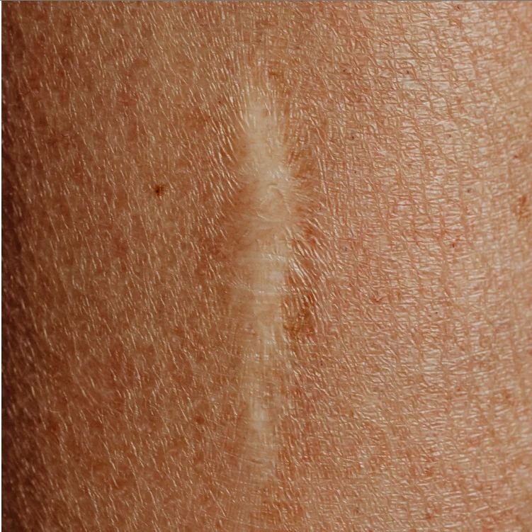 scar